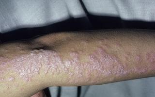 Красный плоский лишай (красный дерматит) – причины, симптомы и проявления на коже, на слизистых оболочках полости рта и половых органов (фото), диагностика